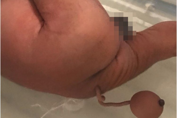 تولد یک نوزاد عجیب الخلقه که دم دارد